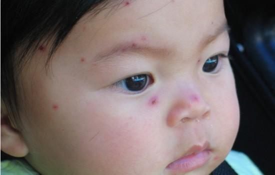 水痘可以吃瓠瓜,瓠瓜助力健康恢复